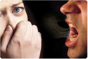 Mouth Odour (bad breath or Halitosis) in Cameroon