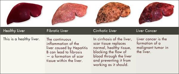 What you need to know about Hepatitis in Cameroon