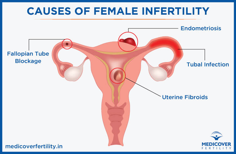 causes-of-female-infertility