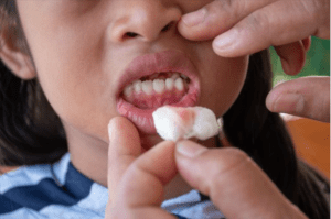 Bleeding Gums, its causes and best treatment with Preventive measures inclusive.