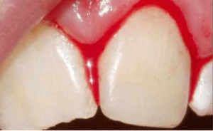 Bleeding gums in Cameroon