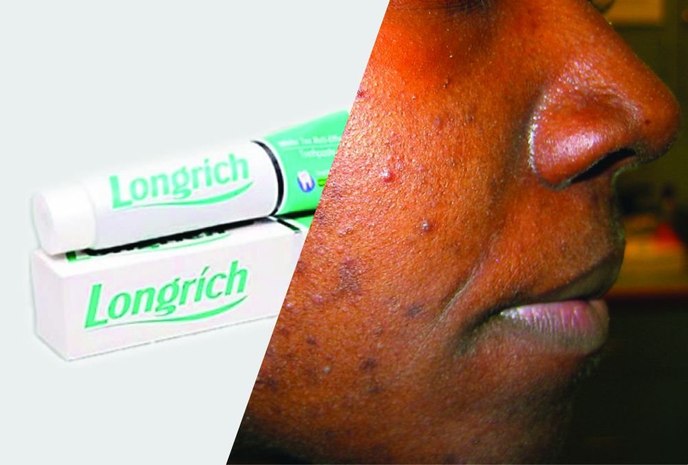 How to use the Longrich toothpaste to treat pimples/acne