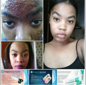 Longrich products for Acne/Pimples/dark spots in Yaounde-Cameroon